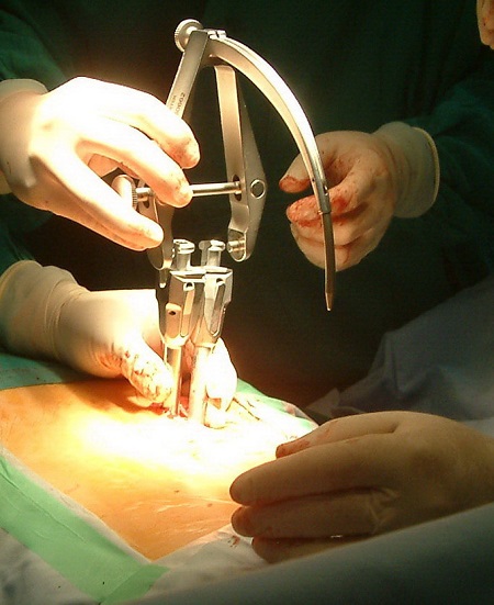 Các bác sĩ đang đặt khung cố định thanh dọc vào các vít trong kỹ thuật mổ nẹp vít qua da điều trị bệnh trượt đốt sống thắt lưng.